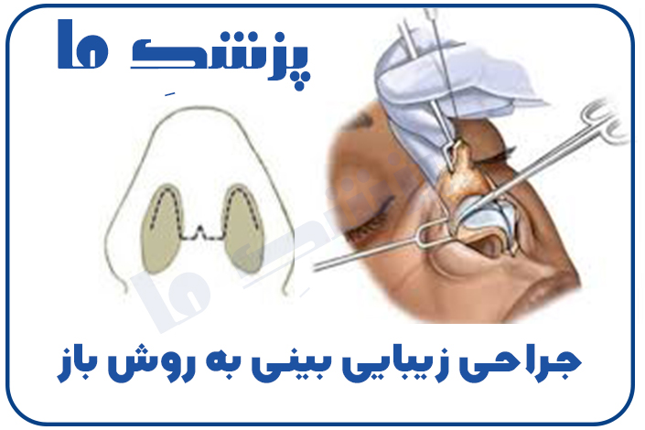 جراحی بینی به روش باز